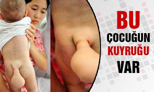 BU ÇOCUÐUN 7.5 CM’LİK KUYRUÐU VAR